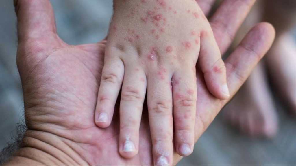 Emite secretaría de salud nuevo aviso epidemiológico por sarampión