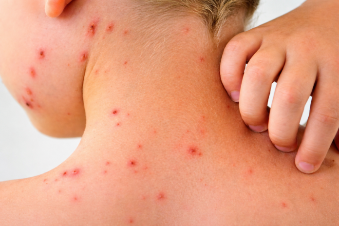 sarampión en México