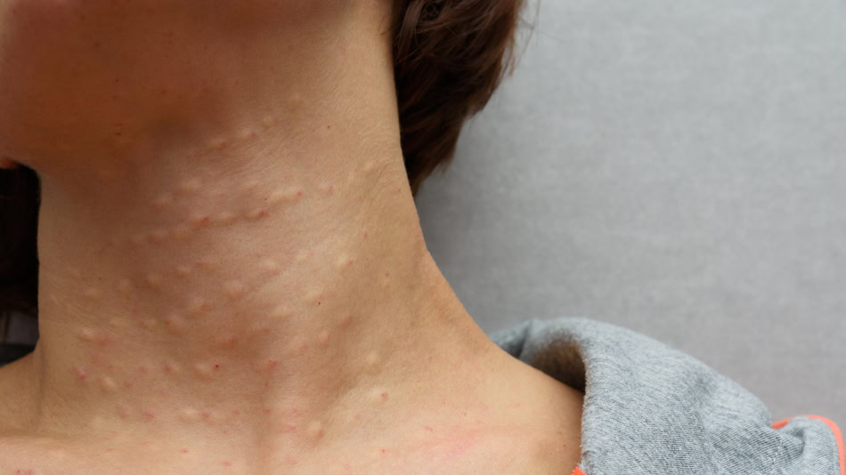 Hoyos en la piel y huecos en las manos Qué son realmente y por qué nos causan tripofobia