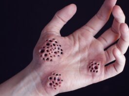 Hoyos en la piel: ¿Qué son realmente y por qué nos causan tripofobia? Hoyos en la piel y huecos en las manos Qué son realmente y por qué nos causan tripofobia