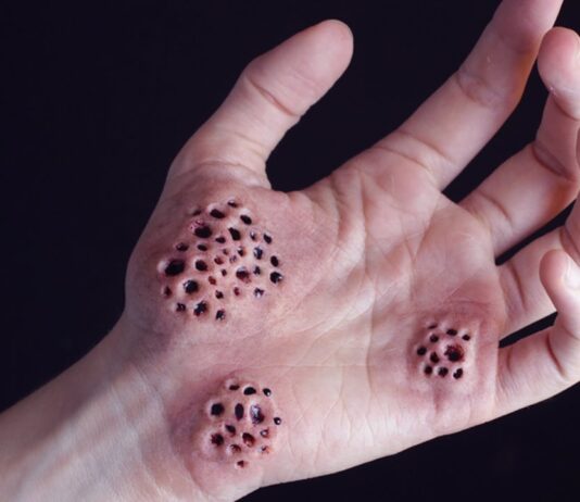 Hoyos en la piel: ¿Qué son realmente y por qué nos causan tripofobia? Hoyos en la piel y huecos en las manos Qué son realmente y por qué nos causan tripofobia