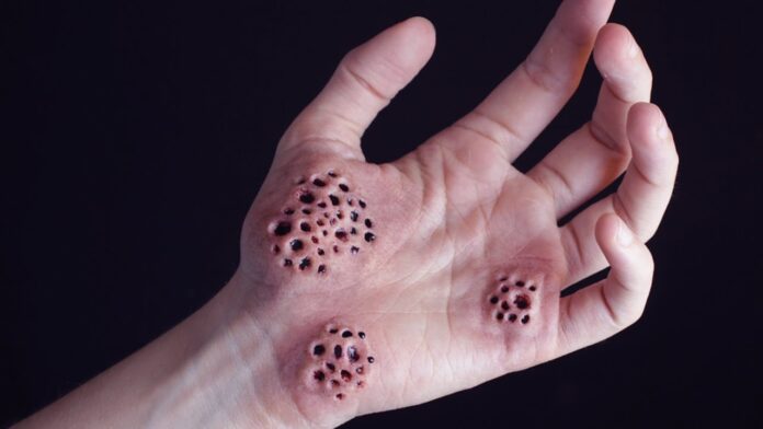 Hoyos en la piel y huecos en las manos Qué son realmente y por qué nos causan tripofobia
