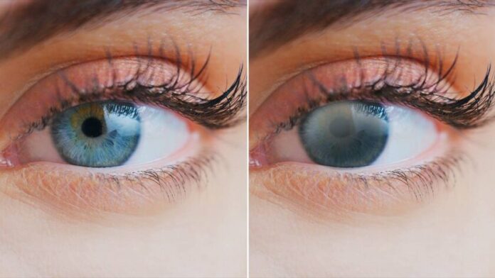 Ilustración que muestra la diferencia entre la ceguera total y la visión de sombras o luces que perciben algunas personas